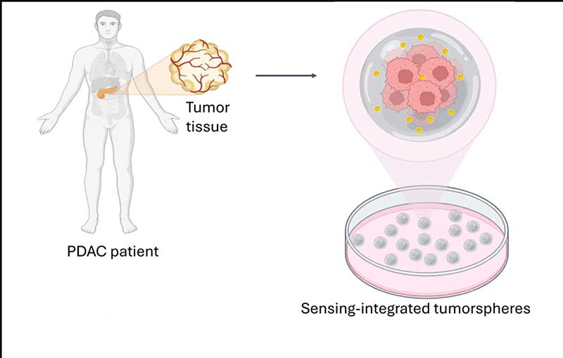 Ricerca UniSalento: tumore del pancreas, sensori “intelligenti” misurano la risposta alla chemioterapia
